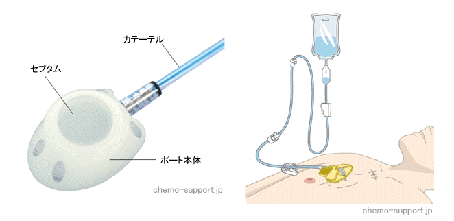 cv ポート の 在宅 で の 自己 管理 指導